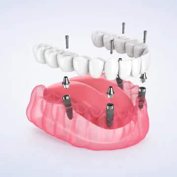 Implant-Supported Dentures: Procedure and After-Care