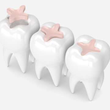 How Long Do Dental Fillings Last? Tips for Maintenance